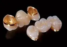 ครอบฟันแบบโลหะผสมด้วยพอร์ซเลน