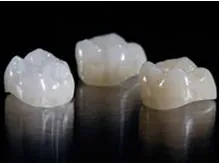 ครอบฟันเซรามิก