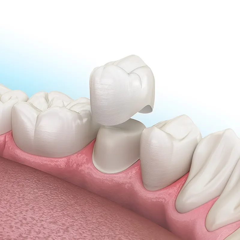 ครอบฟันกราม